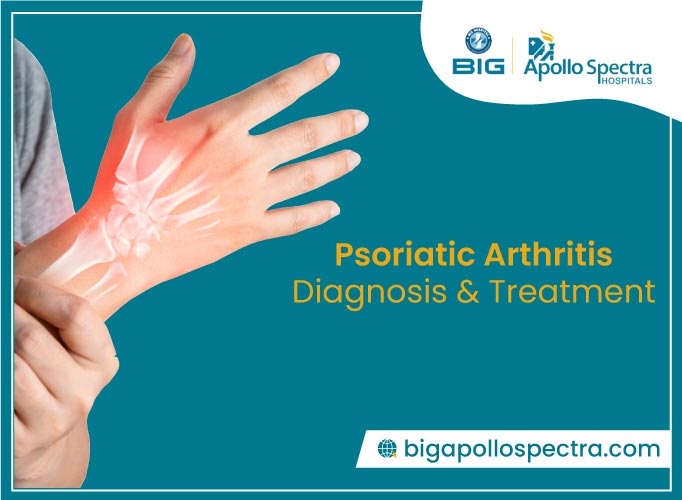 Psoriatic arthritis - Diagnosis & treatment