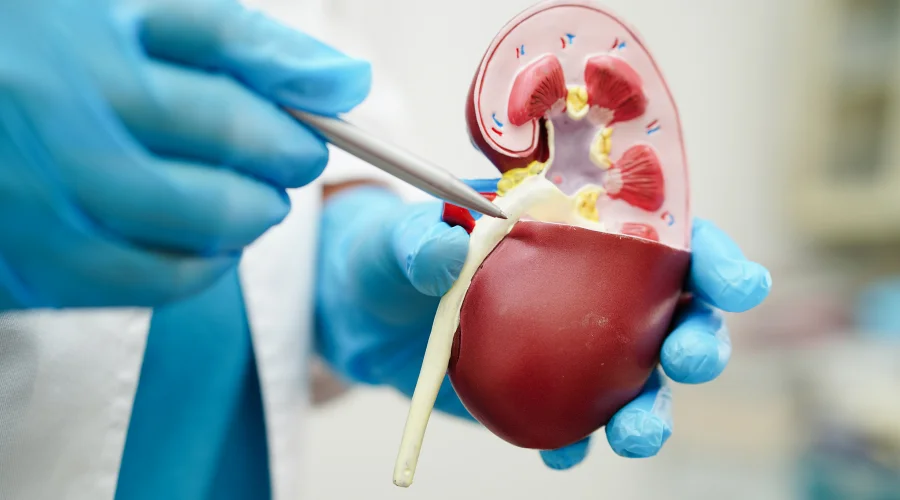 kidney stone treatment Patna