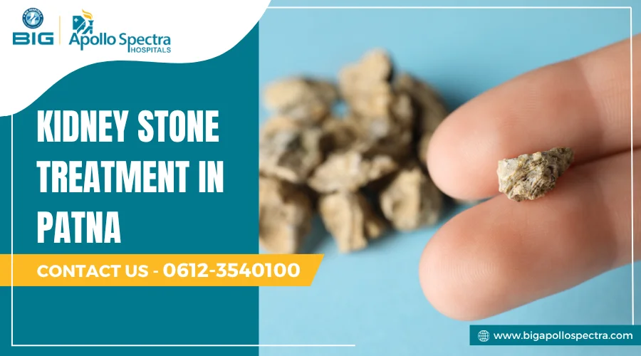 Kidney stone treatment in Patna