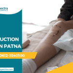 ACL Reconstruction Surgery in Patna