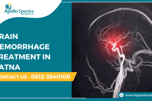 Brain Hemorrhage Treatment in Patna