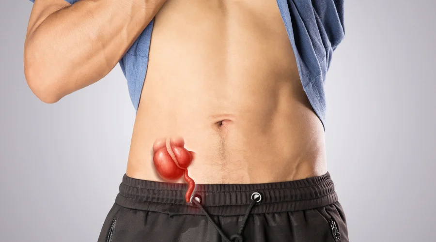 Inflamed Appendicitis