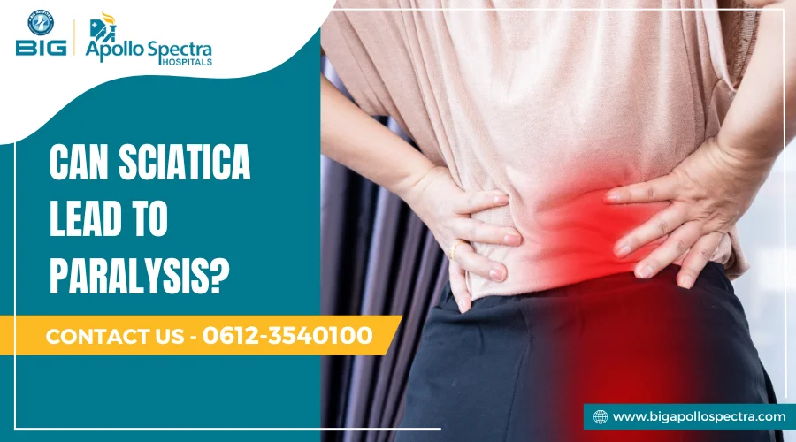 Can sciatica cause paralysis