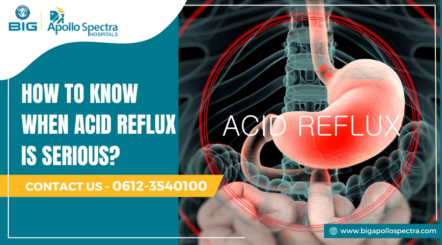 how to know when acid reflux is serious