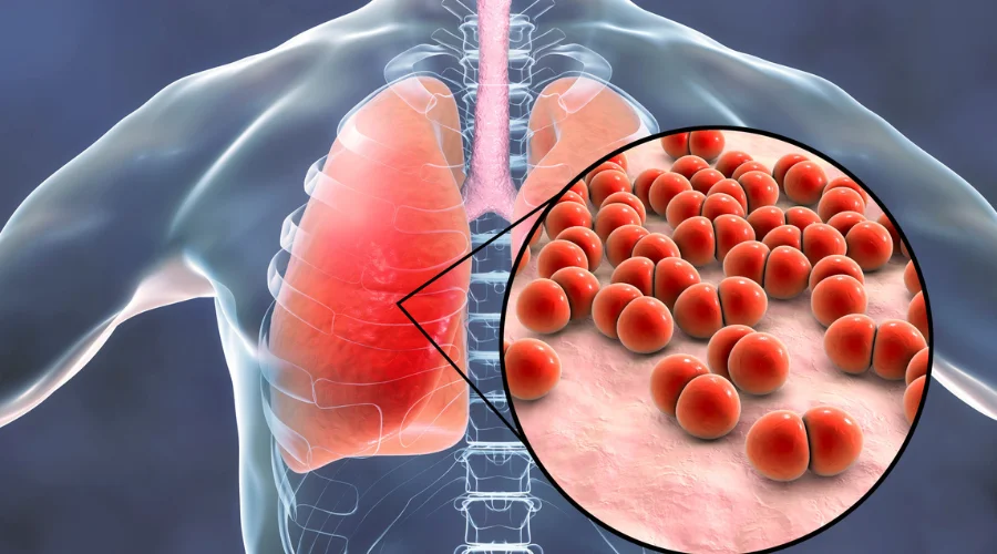 persistent cough symptoms turning into pneumonia