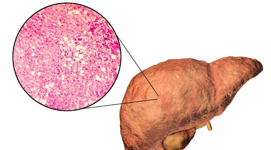 non alcoholic fatty liver