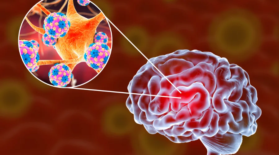 Sinus infection spread to brain