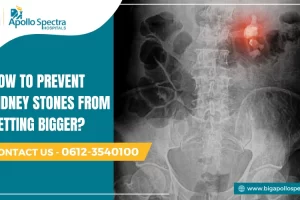 how to prevent kidney stones from getting bigger