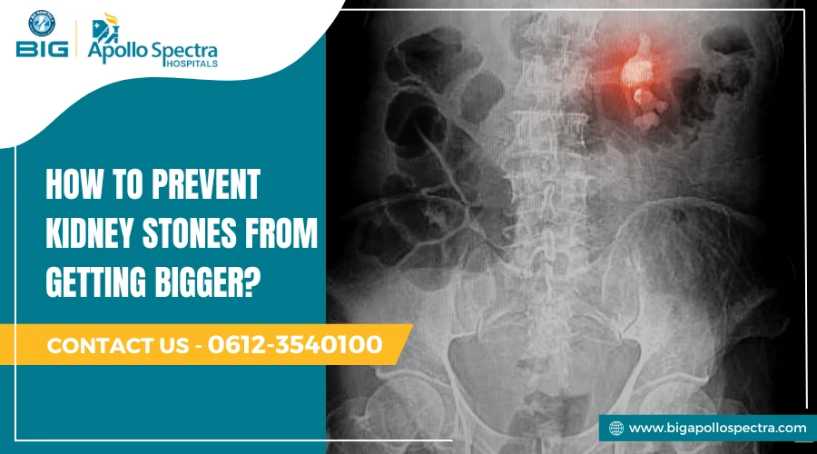 how to prevent kidney stones from getting bigger