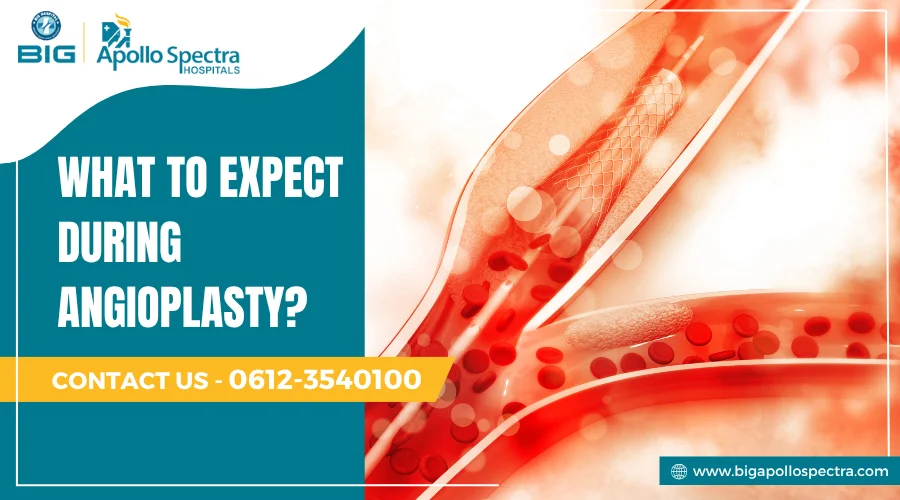 what to expect during angioplasty