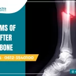 symptoms of shock after broken bone
