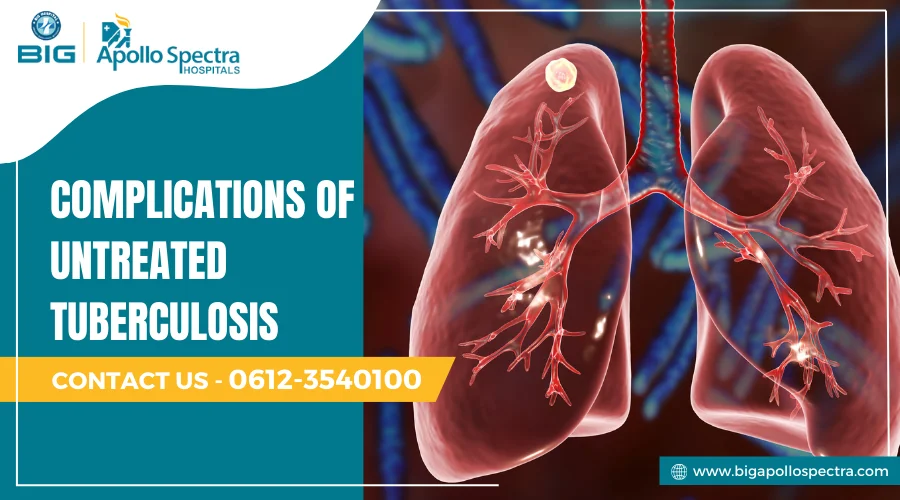 Complications of untreated tuberculosis