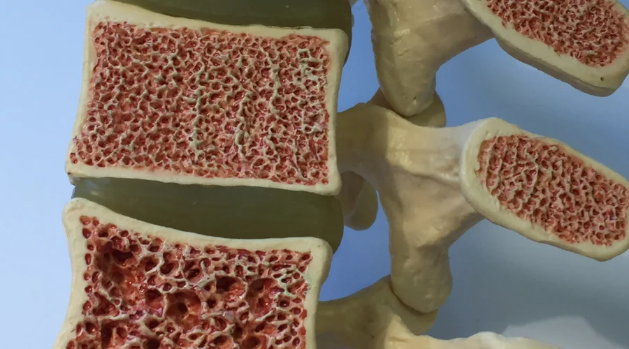 osteoporosis