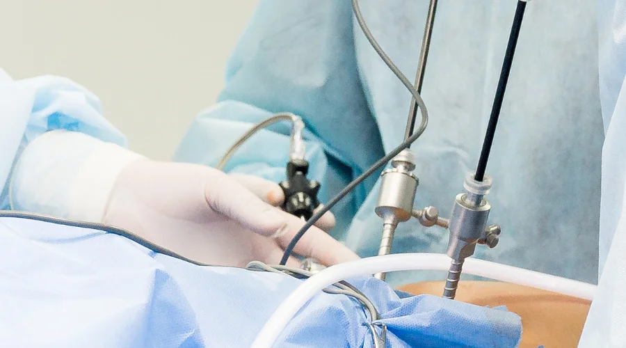 Laparoscopic Surgical procedure