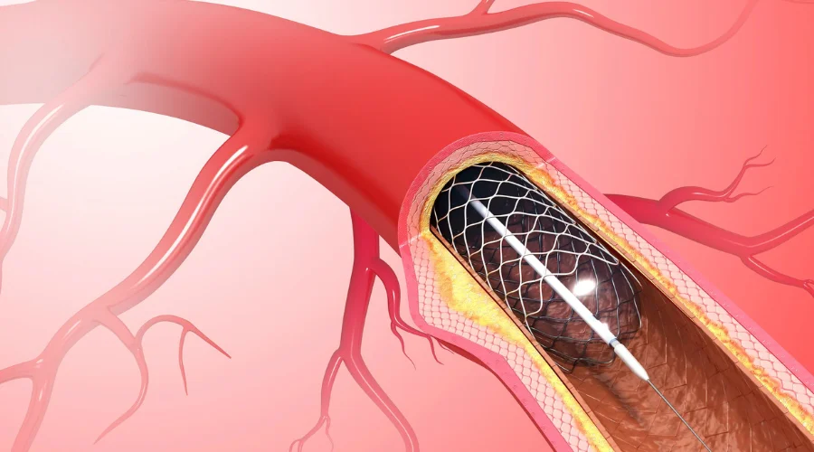 angioplasty