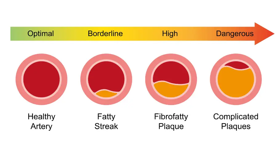 Atherosclerosis stages