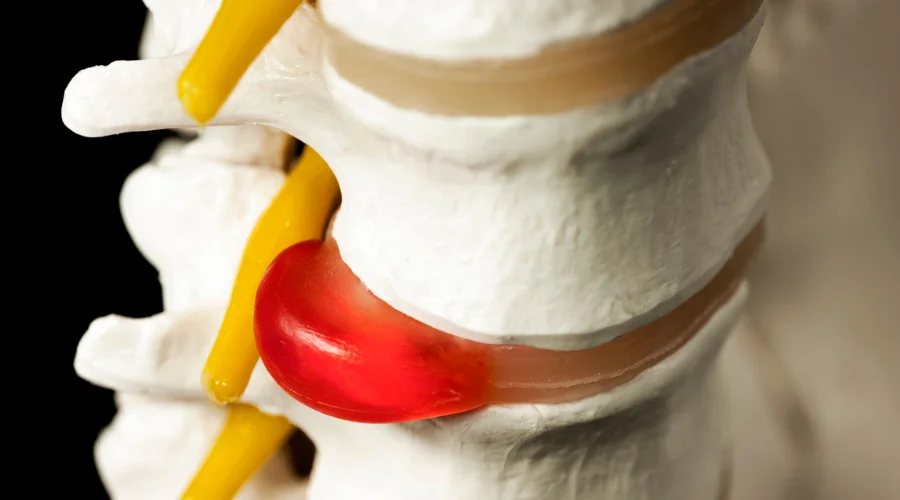 slipped disc