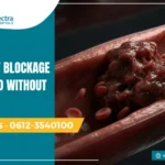 Can Heart Blockage Be Treated Without Surgery