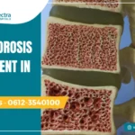 Osteoporosis Treatment in Patna: A Complete Care Guide