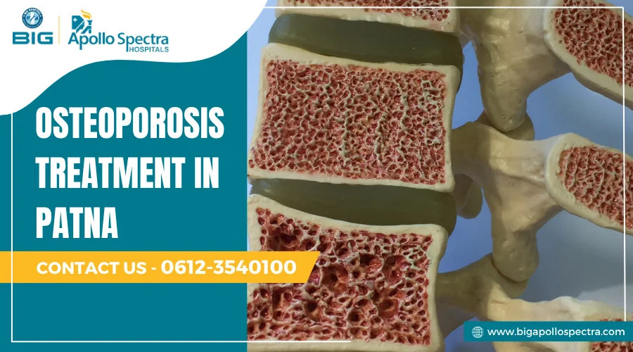 Osteoporosis Treatment in Patna: A Complete Care Guide