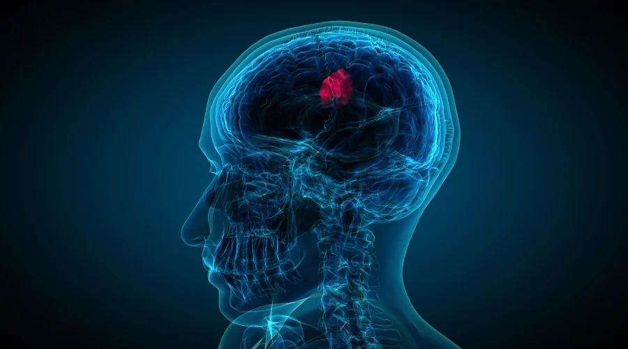 brain tumour