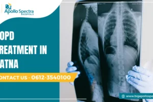 COPD treatment in patna