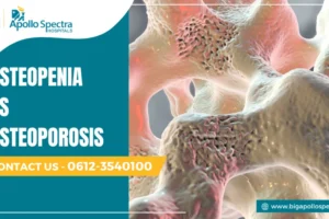 Osteopenia vs Osteoporosis