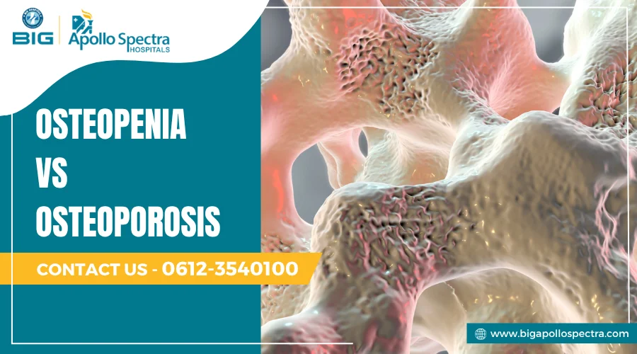 Osteopenia vs Osteoporosis
