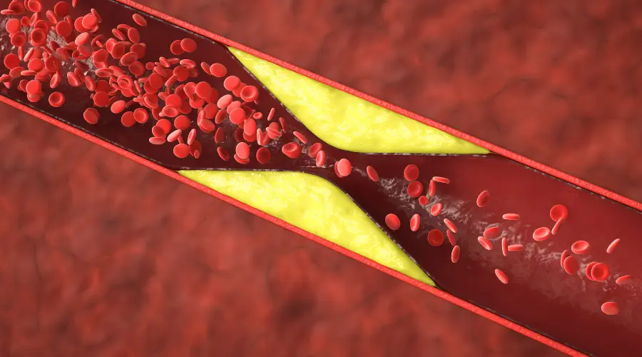artery plaque